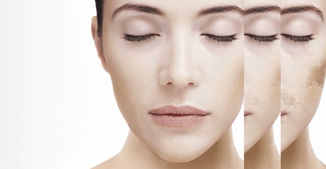 DWHITE-IPERPIGMENTAZIONE